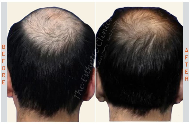 GFC Hair Treatment, gfc  before after photos in mumbai india 